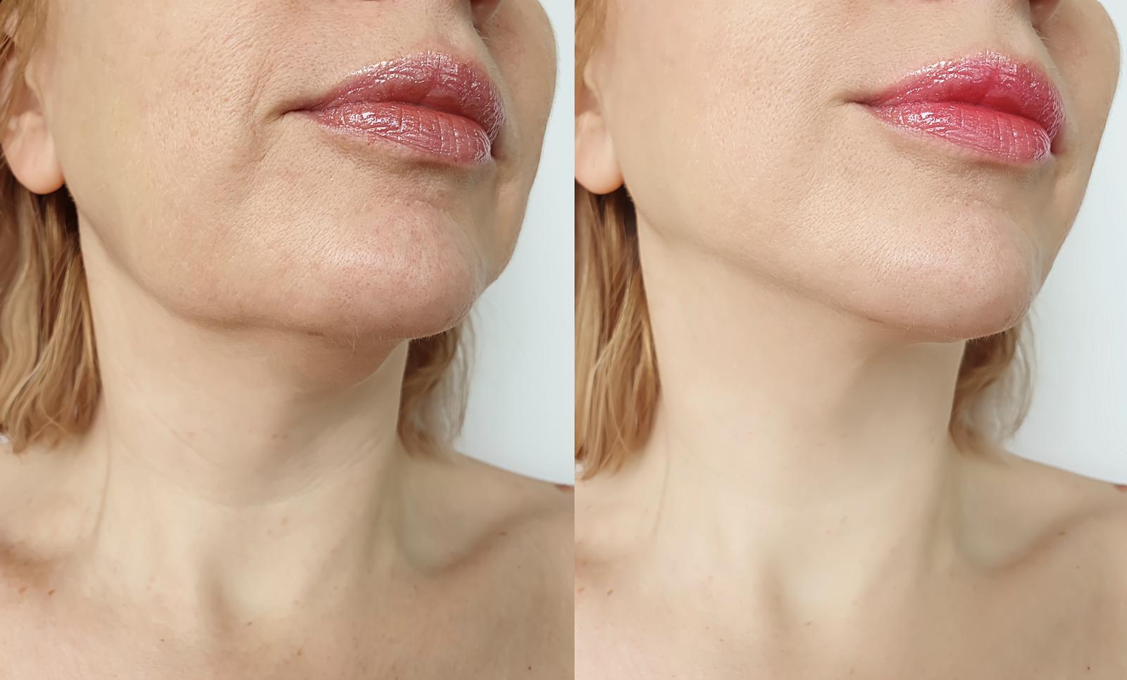 avant et après jawline