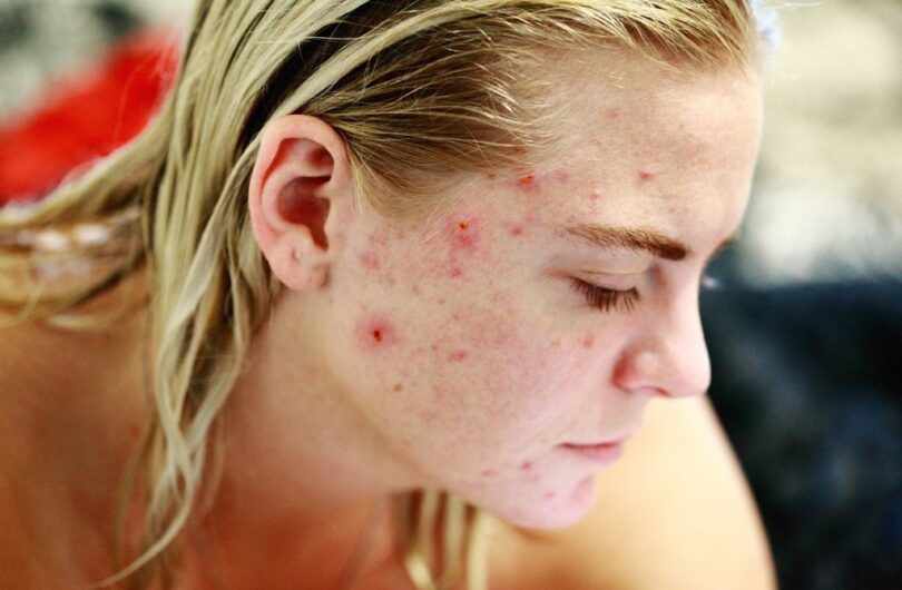 Comment_enlever_les_imperfections_du_visage_?
